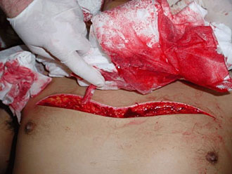 graphic knife wound